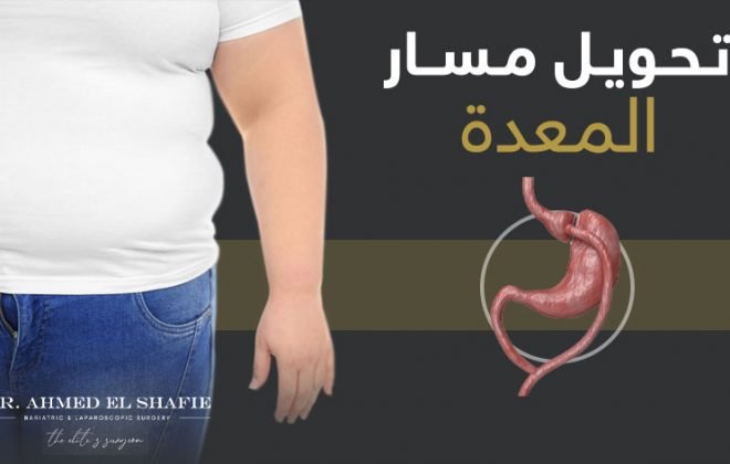 مميزات تحويل مسار المعدة بالمنظار